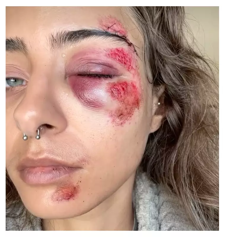 Buraco na Via Engenheiro Roberto Freire: Motorista fica ferido após carro capotar em Niterói