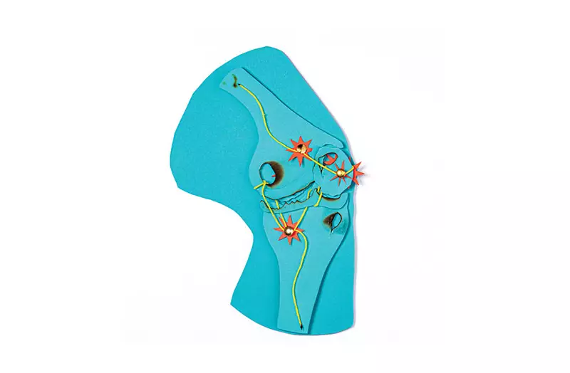 Estudo Revela: Estes São os Exercícios Mais Eficazes Para Quem Sofre com Artrose no Joelho