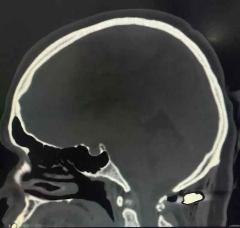 Por Apenas 4mm: Mulher Escapa da Tetraplegia Após Ser Atingida por Bala Perdida no Paraná