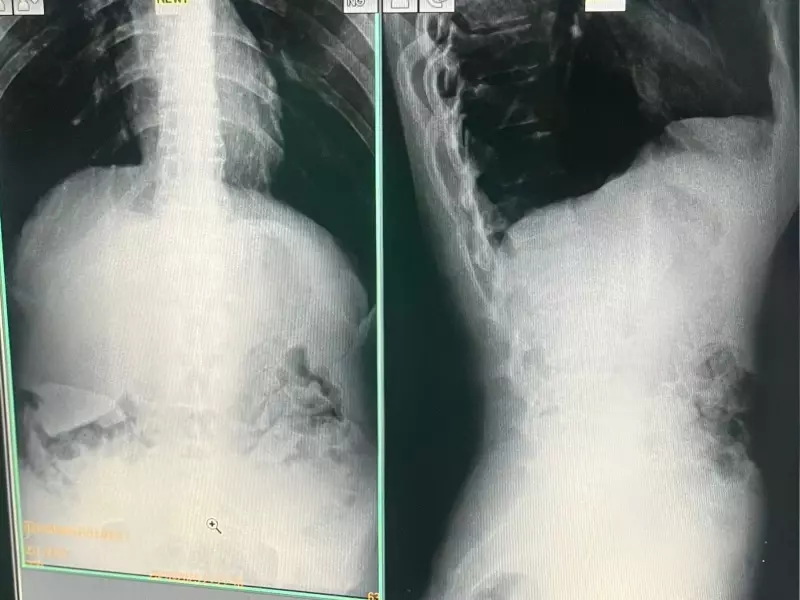 Presos Engolem Drogas em Saidinha e São Flagrados em Governador Valadares