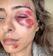 Buraco na Via Engenheiro Roberto Freire: Motorista fica ferido após carro capotar em Niterói