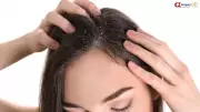 Caspa Pode Causar Queda de Cabelo? Descubra a Relação e Como Tratar
