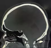 Por Apenas 4mm: Mulher Escapa da Tetraplegia Após Ser Atingida por Bala Perdida no Paraná