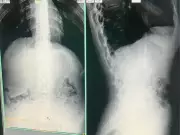 Presos Engolem Drogas em Saidinha e São Flagrados em Governador Valadares