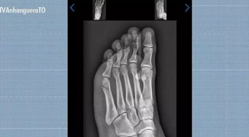 Candidato supera fratura no pé e é aprovado no TAF da PMTO com 3s de sobra