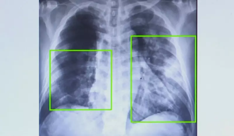 Casos de pneumonia dobram em Campinas e crescem 20% no estado