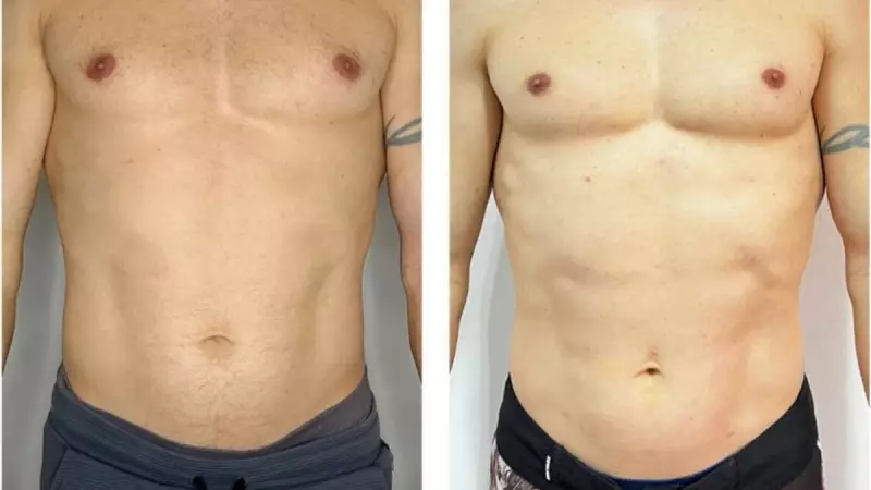 Endolipo®️: Santa Catarina lança cursos de certificação em 2025