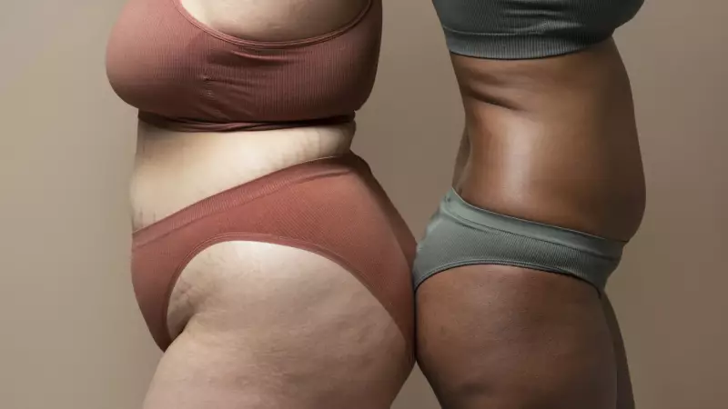 Lipedema: a doença desconhecida que afeta milhares de mulheres no Brasil