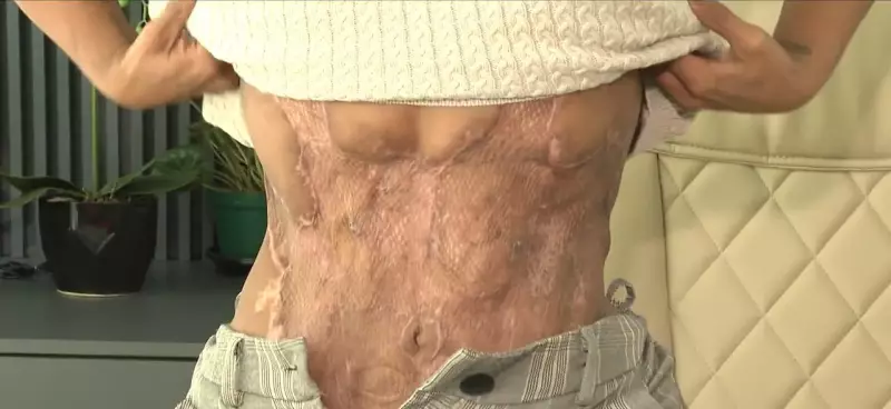 Necrose Após 12 Cirurgias em Um Dia: Paciente de SC Vive Drama em Hospital Público