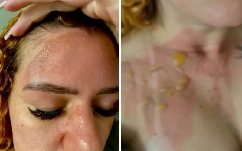 Panela de Pressão Explode e Deixa Empresária com Queimaduras Graves em Goiás | CUIDADOS