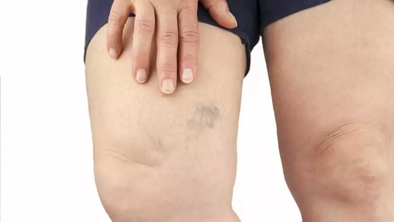 Varizes: 38% dos brasileiros sofrem com o problema que vai além da estética