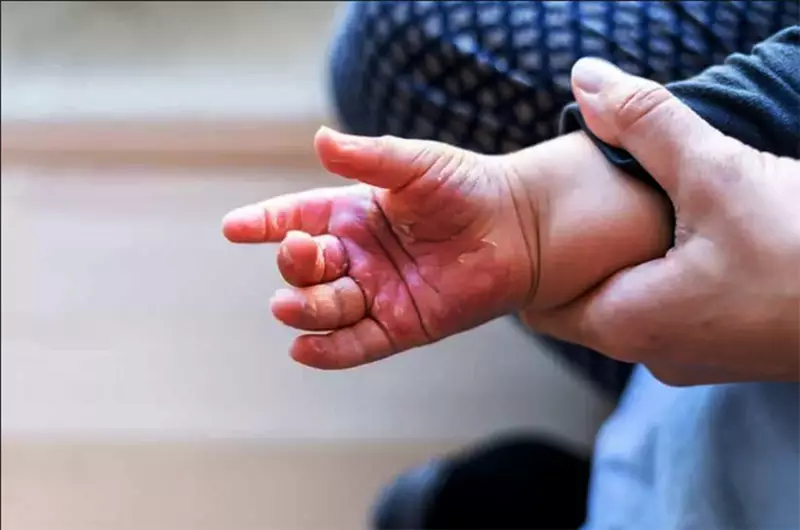 Amapá registra 15 casos de queimaduras em crianças de 1 a 4 anos em 2025