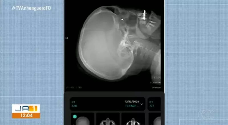 Chumbinho fica alojado atrás do olho de servidora em barraca irregular em Palmas
