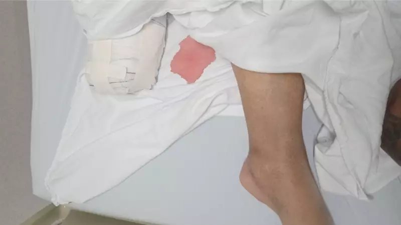 Fila de 12 pessoas para internação na Santa Casa de Araçatuba leva a amputação de pé