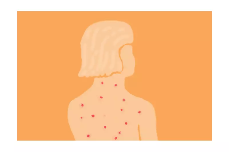 São Paulo registra 2º caso de sarampo importado em 2025; vacinação é intensificada