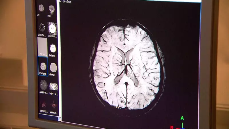 Vacina contra herpes zóster reduz risco de demência em 20%, revela estudo