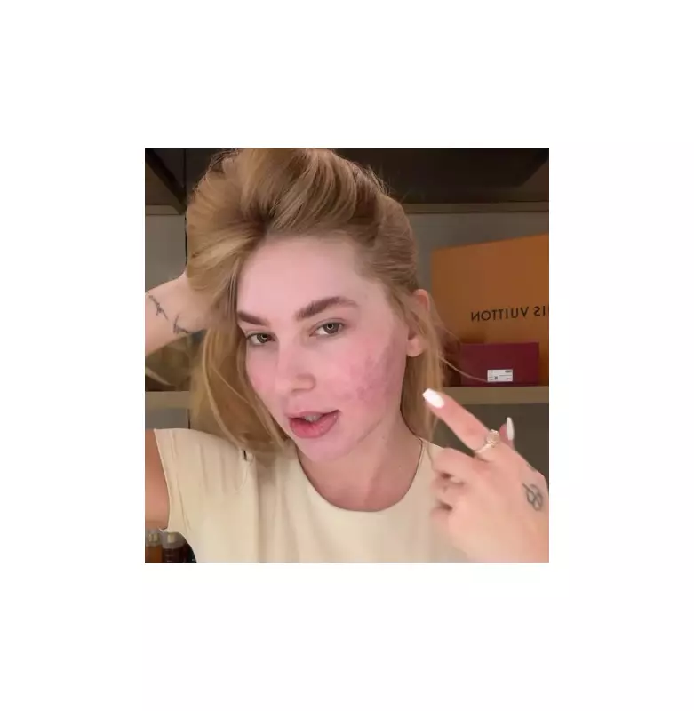 Virginia Fonseca se arrepende de procedimento estético que deixou rosto 'em carne viva'