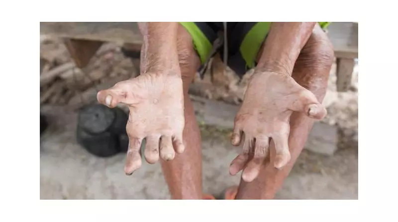 Acre registra 240 novos casos de hanseníase em 2025 e reforça alerta do Janeiro Roxo