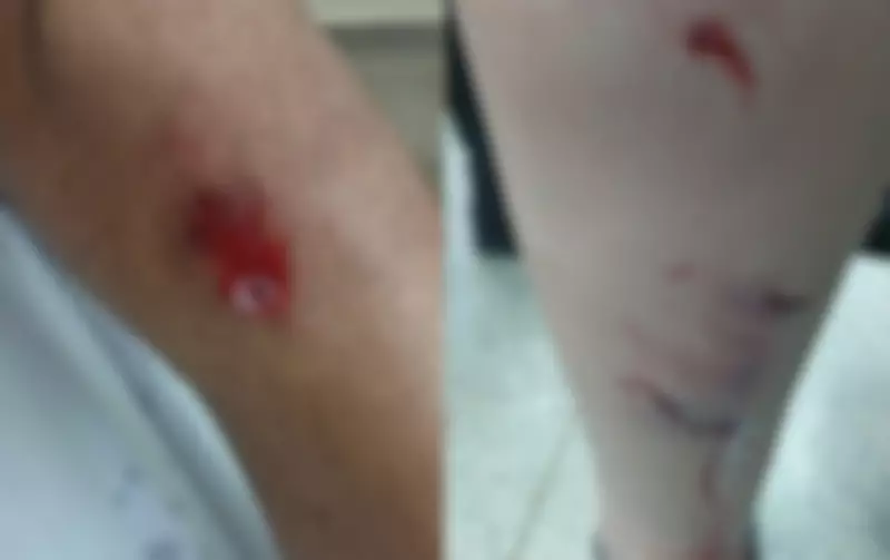 Ataque de Pitbull fere dois jovens em Cesário Lange; tutor é identificado