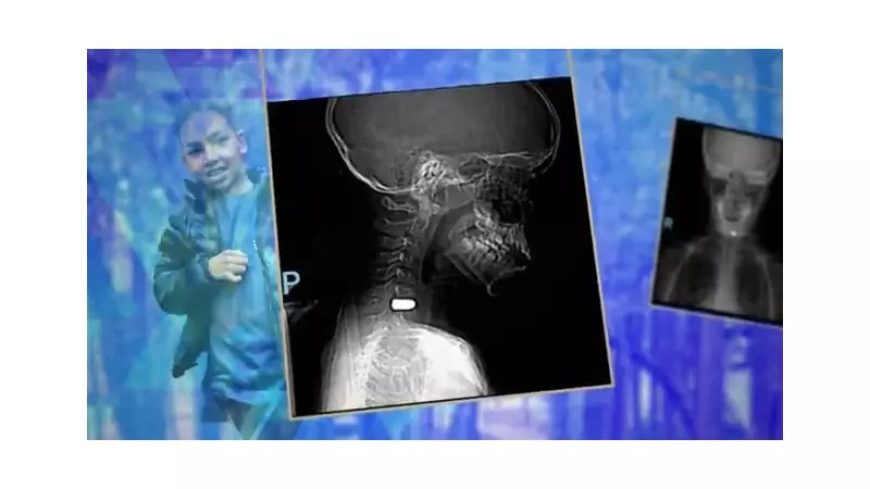 Criança baleada por bala perdida em SP recupera movimentos mesmo com projétil alojado