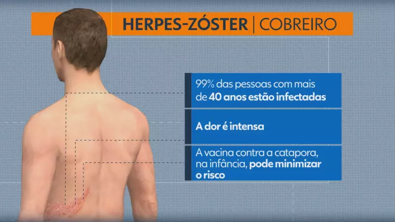 Herpes-zóster: casos disparam 122% em Piracicaba; estresse e vida moderna afetam jovens