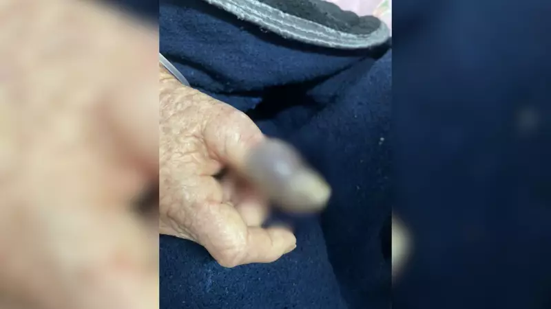 Idosa de 76 anos aguarda vaga hospitalar após dedo necrosar por suspeita de picada de aranha em São José do Rio Preto