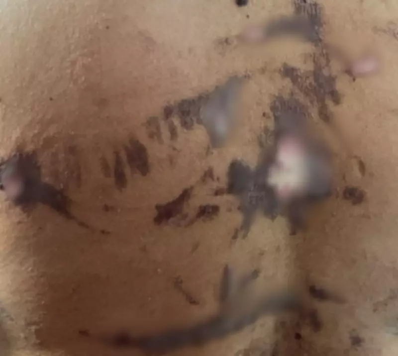 Mulher relata queimaduras após cesariana e falta de apoio em hospital de Arraial do Cabo