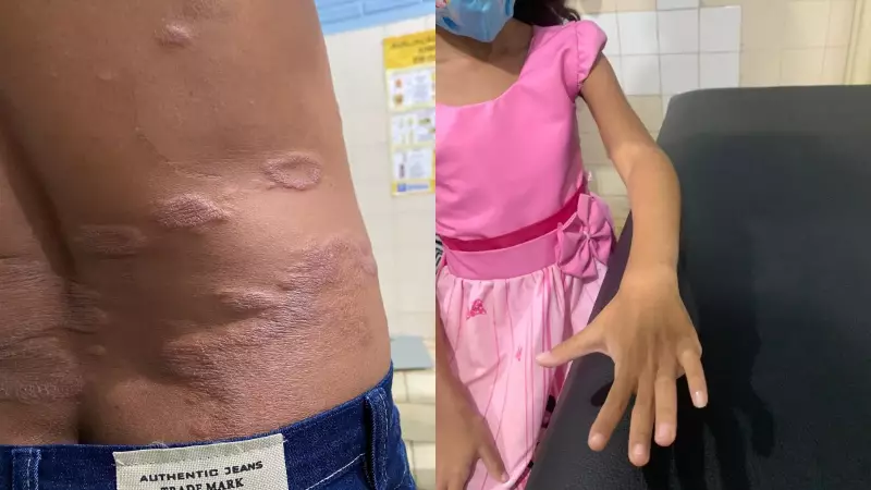 Piauí tem quinta maior taxa de hanseníase do Brasil, aponta boletim epidemiológico