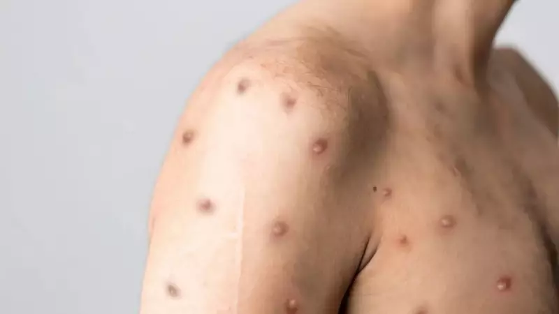 São Paulo registra 2º caso de nova cepa mais letal de Mpox