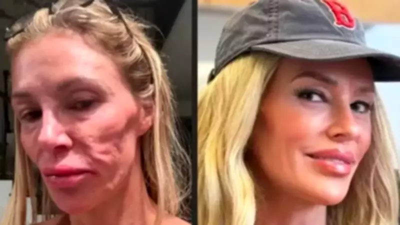 Brandi Glanville revela gasto de R$ 1 milhão para diagnosticar problema facial