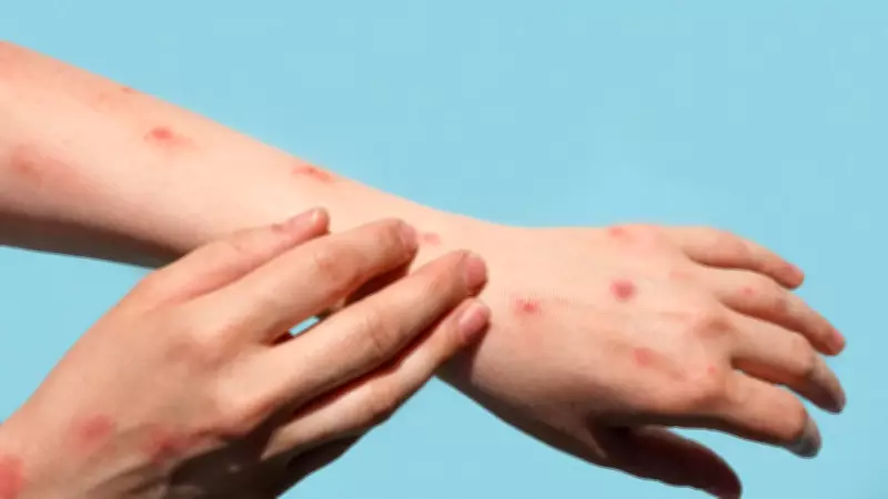 Brasil registra 48 casos de mpox em 2026, com maioria concentrada em São Paulo