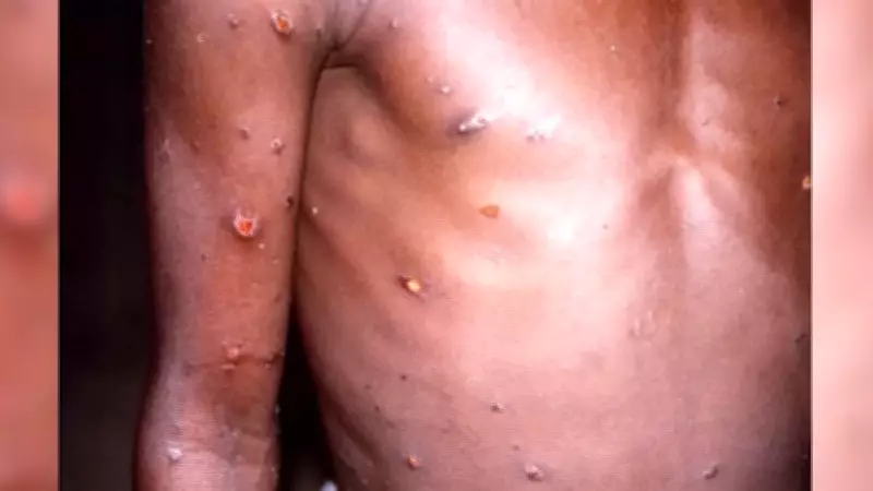 Casos de Mpox em Rondônia sobem para seis, com pacientes em isolamento