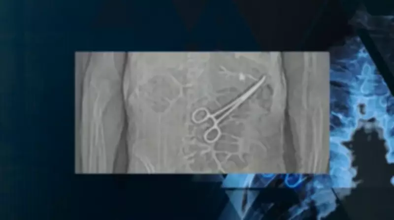 Erros cirúrgicos no Brasil: pinças, gazes e compressas esquecidas dentro de pacientes
