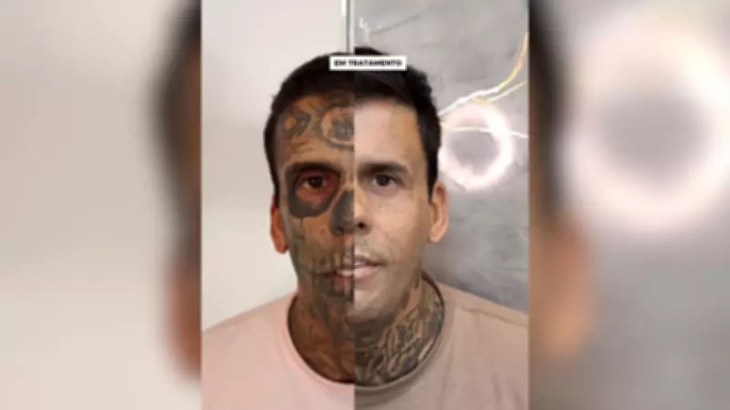 Ex-'mais tatuado do Brasil' avança na remoção facial e inicia nova vida em Pernambuco