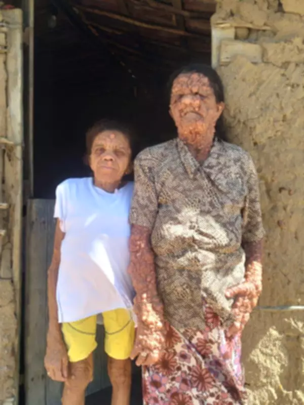Mãe e filha enfrentam neurofibromatose rara e preconceito no Agreste da Paraíba