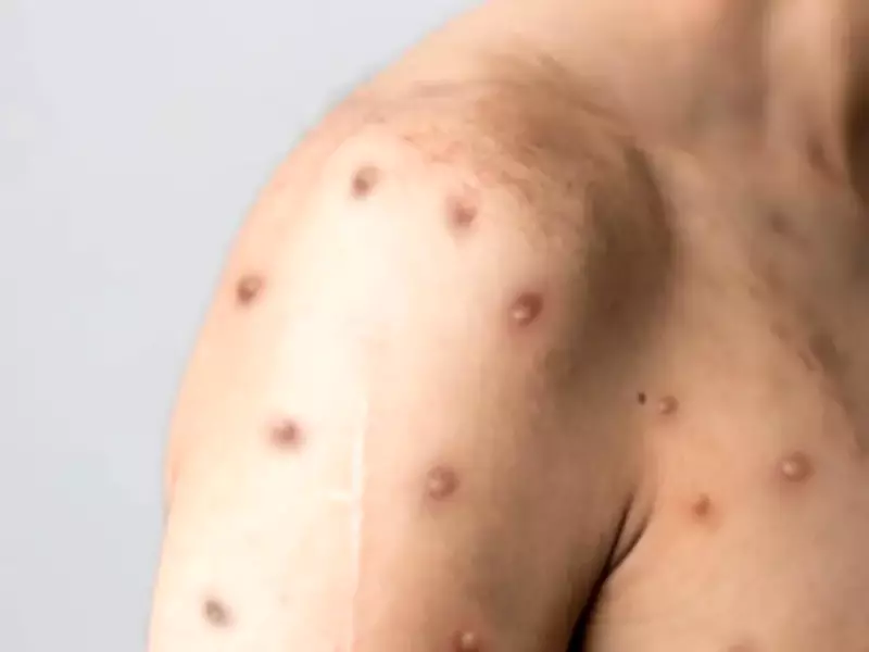 Minas Gerais confirma primeiro caso de mpox em 2026 na região Centro-Oeste do estado