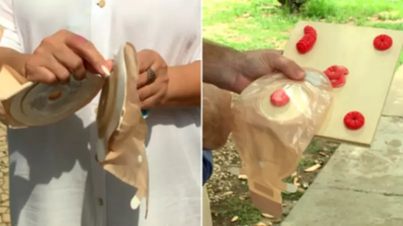 Pacientes ostomizados em Teresina há um ano sem bolsas do SUS, denunciam dor e risco de infecção