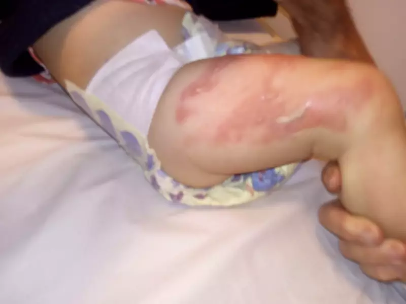 Prefeitura de Limeira é condenada a pagar R$ 20 mil por queimadura de bebê em creche