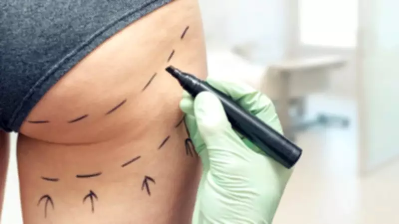 Reino Unido intensifica ofensiva contra 'Brazilian butt lift' após casos graves