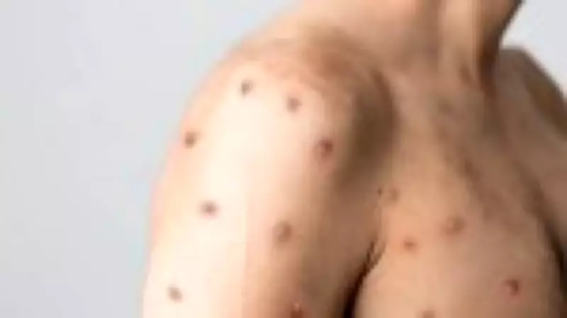 Surto de Mpox no Brasil: Casos ultrapassam 60 e São Paulo lidera ocorrências