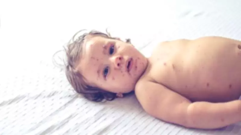 Surto de sarampo nos EUA alerta para queda na vacinação e risco de novas epidemias