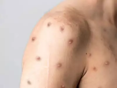 Paraná registra primeiro caso de Mpox em 2026; paciente é paraguaio atendido em Foz do Iguaçu