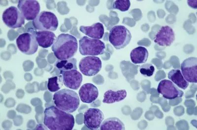 Terapias-alvo triplicam sobrevida na leucemia, mas acesso a testes moleculares desafia Brasil