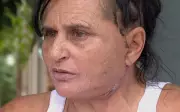 Mulher denuncia complicações graves após procedimento estético feito por dentista em Ribeirão Preto