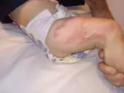 Prefeitura de Limeira é condenada a pagar R$ 20 mil por queimadura de bebê em creche