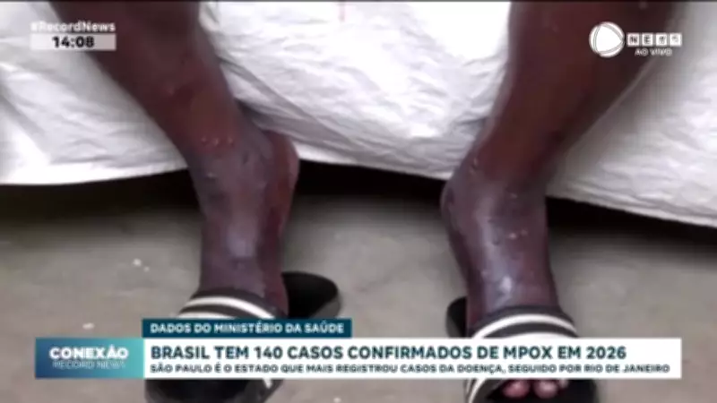 Brasil registra 140 casos confirmados de Mpox em 2026, sem mortes