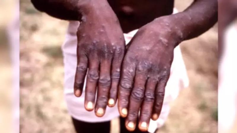 Brasil registra 140 casos de Mpox em 2026; Ceará confirma terceira infecção