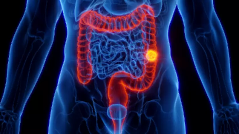 Câncer colorretal pode causar 635 mil mortes e perdas de US$ 22,6 bi no Brasil até 2030