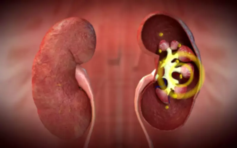 Estudo revela que bactérias estão presentes dentro dos cálculos renais mais comuns