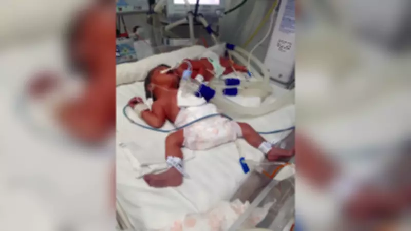 Gêmeas unidas pela cabeça têm terceira cirurgia de separação bem-sucedida em Ribeirão Preto